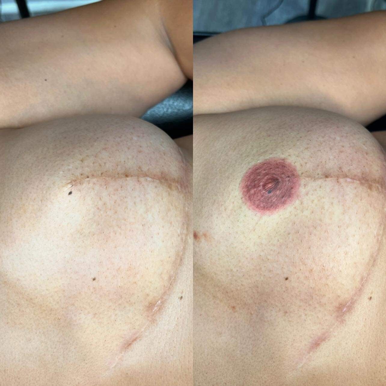 Natural areola look post-reconstruction.